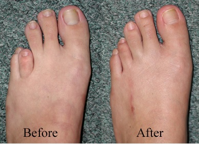 short toe lengthening procedure