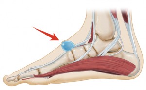 Ganglion cyst